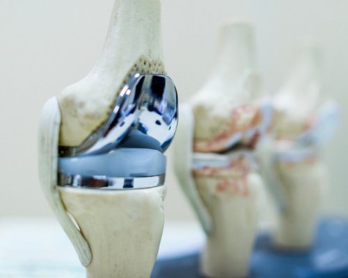 Joint Replacement