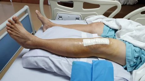 Joint Replacement Procedure