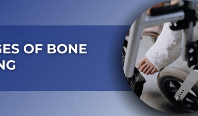 6 Stages of Bone Healing