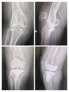 Knee Replacement Safe for People Over