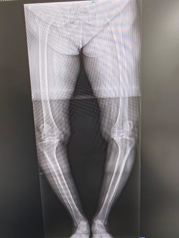 Severe osteoarthritis of both knee joints X-ray showing cartilage loss
