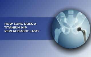 How Long Does A Titanium Hip Replacement Last?