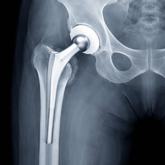 Titanium hip replacement implant showing durability and longevity
